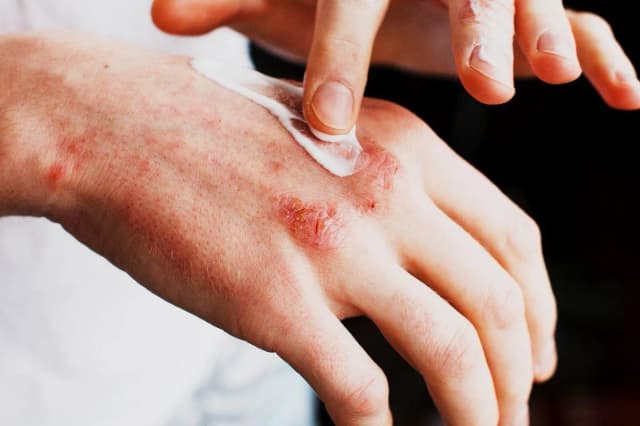 Alergia na sierść objawy skórne – jak je rozpoznać i leczyć Alergia na sierść objawy skórne – jak je rozpoznać i leczyć